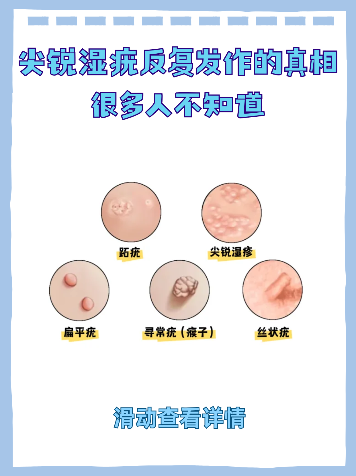 尖锐湿疣怎么治疗才能根治不传染_(尖锐湿疣怎么治疗才能根治不传染家人) 第2张 尖锐湿疣怎么治疗才能根治不传染_(尖锐湿疣怎么治疗才能根治不传染家人) 第2张