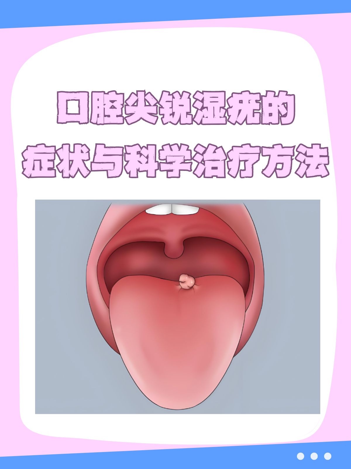 尖锐湿疣怎么治疗才能根治口腔_(尖锐湿疣怎么治疗才能根治口腔溃疡)  第1张