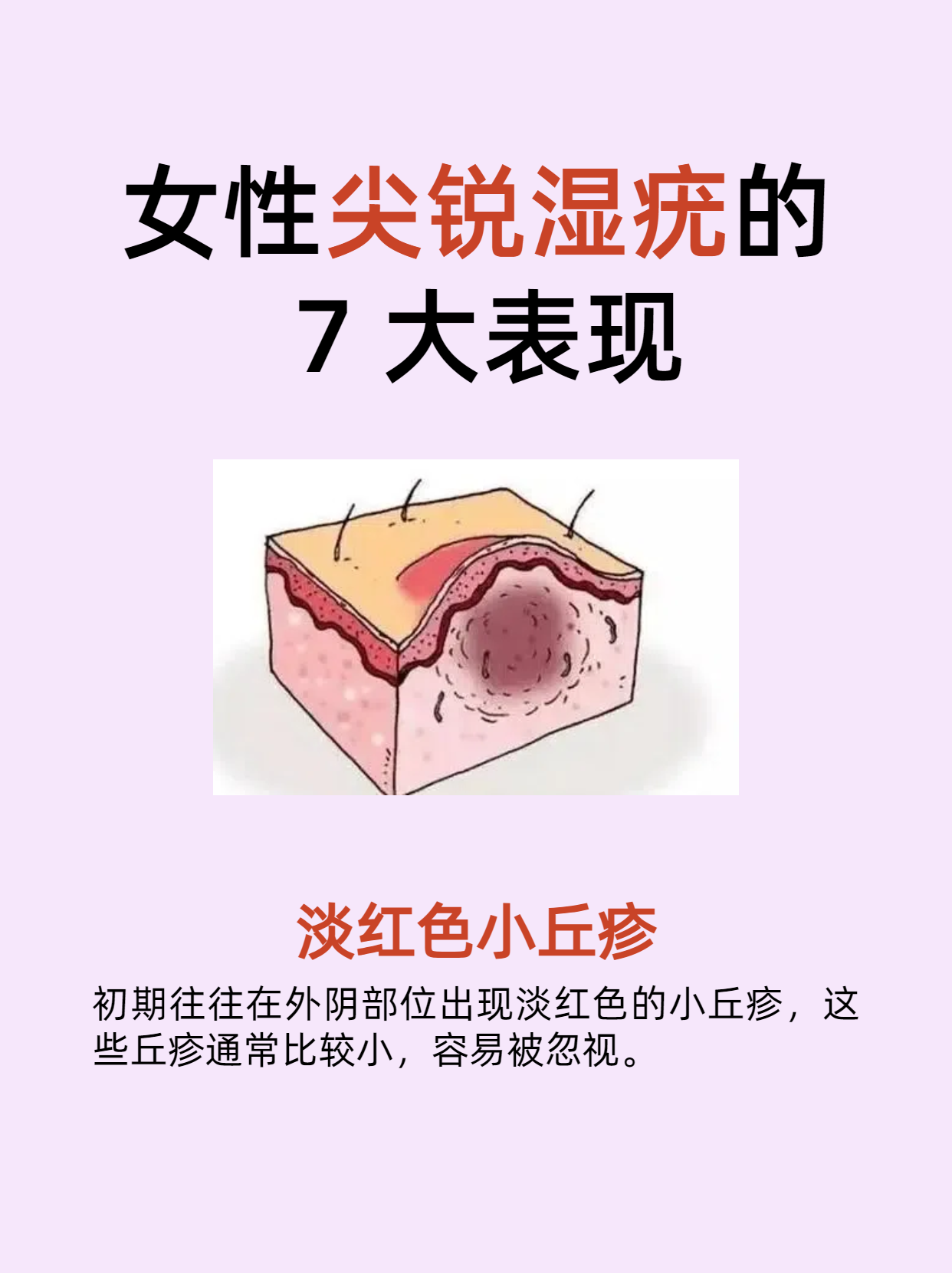 尖锐湿疣初期症状图片_(尖锐湿疣初期症状图片口腔) 第2张 尖锐湿疣初期症状图片_(尖锐湿疣初期症状图片口腔) 第2张